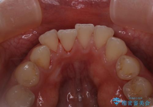 インビザラインのアタッチメントをつける前にPMTCの治療後