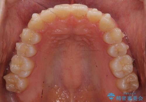 前歯のがたつき インビザラインで 下の奥歯を後ろに下げるの治療中