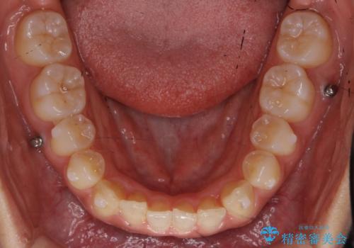 前歯のがたつき　インビザラインで　下の奥歯を後ろに下げるの治療中