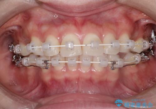 口が閉じにくい　口ゴボの抜歯矯正による改善の治療中