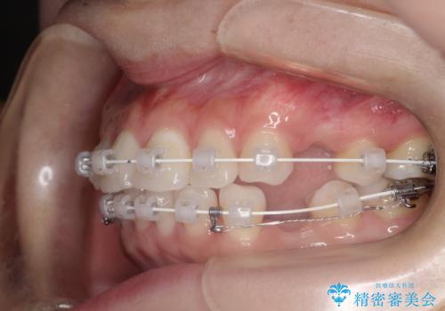口が閉じにくい 口ゴボの抜歯矯正による改善の治療中