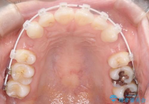 口が閉じにくい 口ゴボの抜歯矯正による改善の治療中