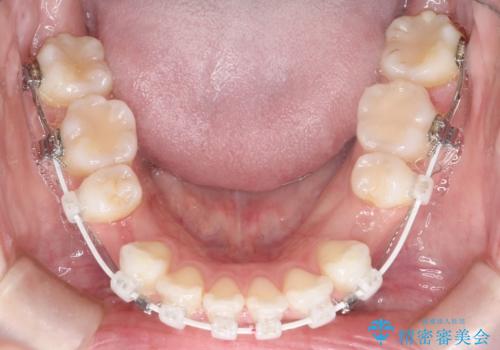 口が閉じにくい 口ゴボの抜歯矯正による改善の治療中