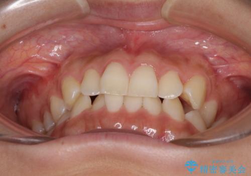 乳歯を抜いてインプラントに 咬み合わせ改善のインビザライン矯正の治療前