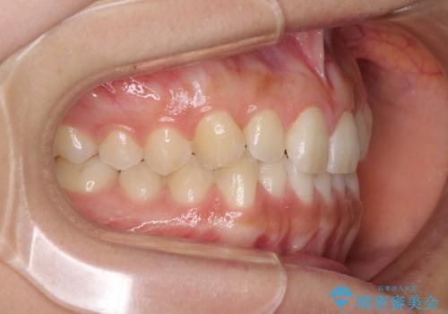 乳歯を抜いてインプラントに　咬み合わせ改善のインビザライン矯正の治療前
