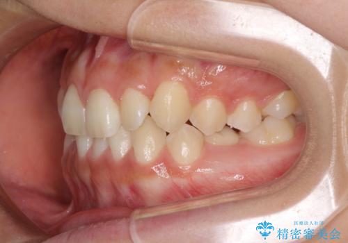 乳歯を抜いてインプラントに 咬み合わせ改善のインビザライン矯正の治療前