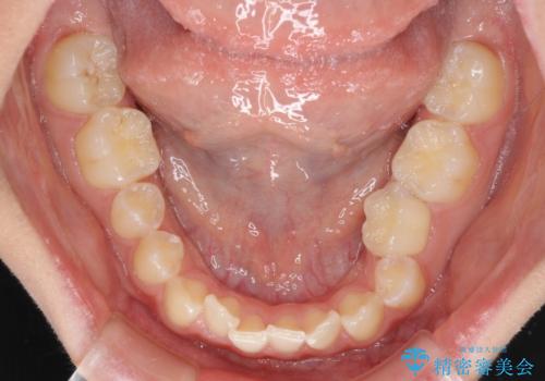 乳歯を抜いてインプラントに 咬み合わせ改善のインビザライン矯正の治療前