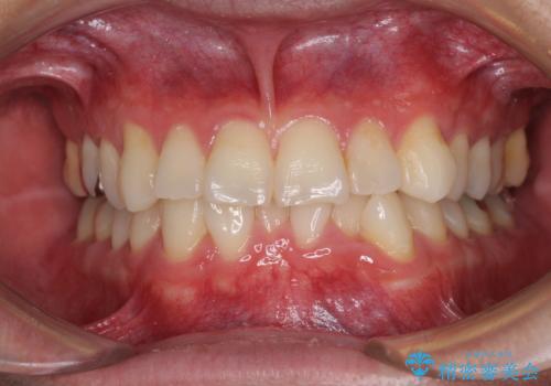 冷たいものがしみて奥歯が痛い 気になる歯並びも治したの症例 治療前