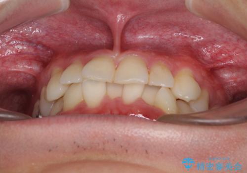 冷たいものがしみて奥歯が痛い 気になる歯並びも治したの治療前