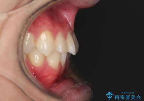 冷たいものがしみて奥歯が痛い 気になる歯並びも治したの治療前