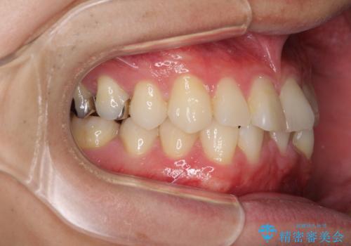 冷たいものがしみて奥歯が痛い 気になる歯並びも治したの治療前