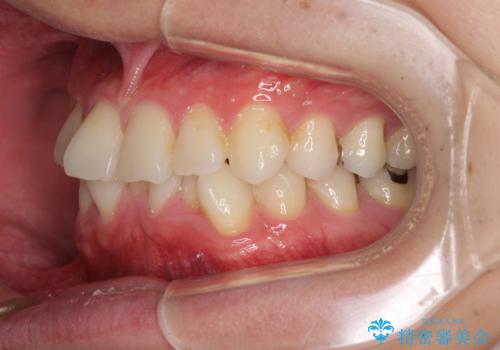 冷たいものがしみて奥歯が痛い 気になる歯並びも治したの治療前