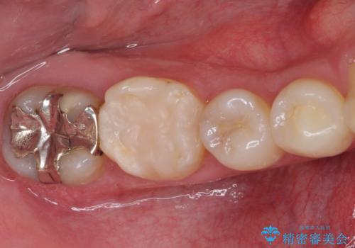 冷たいものがしみて奥歯が痛い 気になる歯並びも治したの治療前