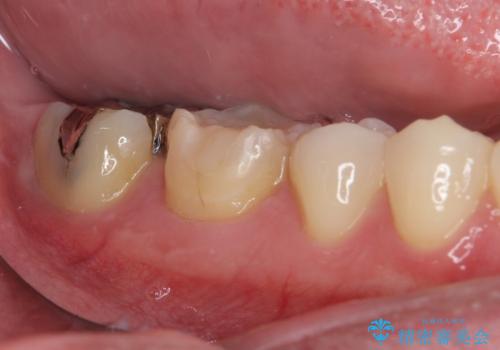 冷たいものがしみて奥歯が痛い 気になる歯並びも治したの治療前