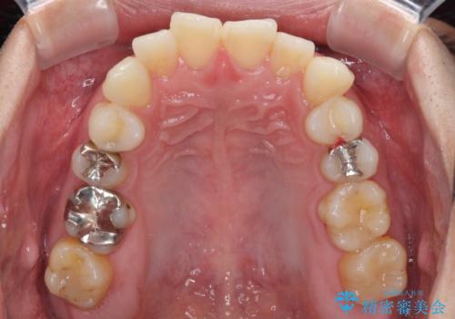 冷たいものがしみて奥歯が痛い 気になる歯並びも治したの治療前