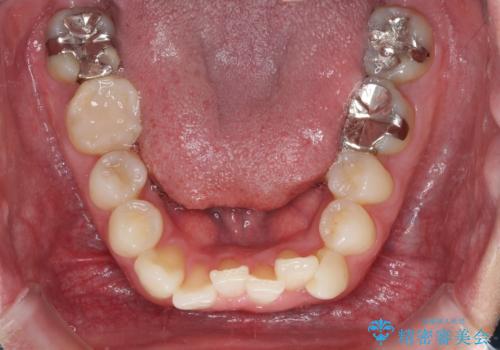 冷たいものがしみて奥歯が痛い 気になる歯並びも治したの治療前