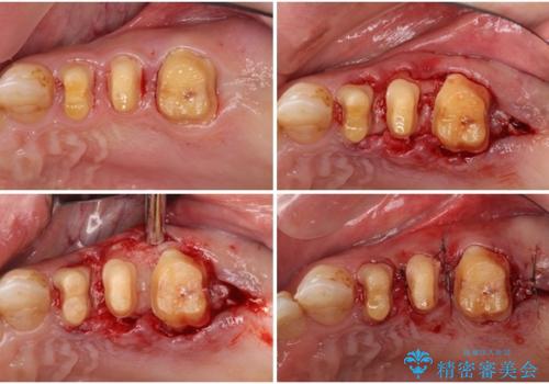歯列不正と歯周病 総合歯科治療による全顎治療の治療前