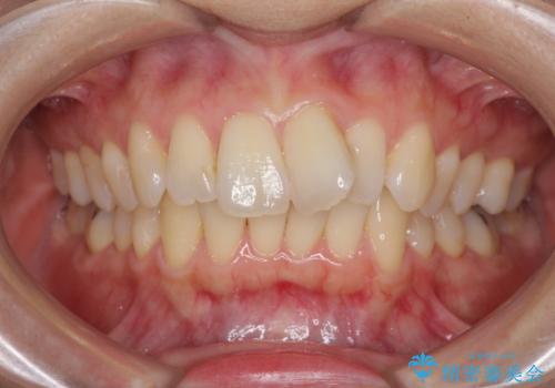 短期間で仕上げたい ワイヤーでの非抜歯矯正の症例 治療前