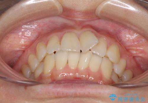 短期間で仕上げたい ワイヤーでの非抜歯矯正の治療前