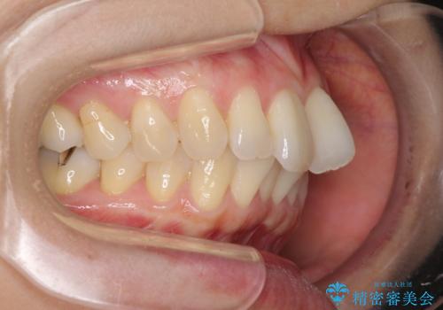 短期間で仕上げたい ワイヤーでの非抜歯矯正の治療前