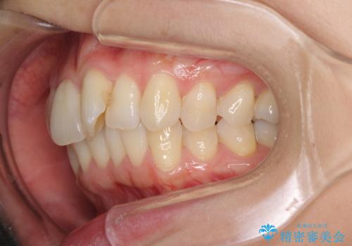 短期間で仕上げたい ワイヤーでの非抜歯矯正の治療前