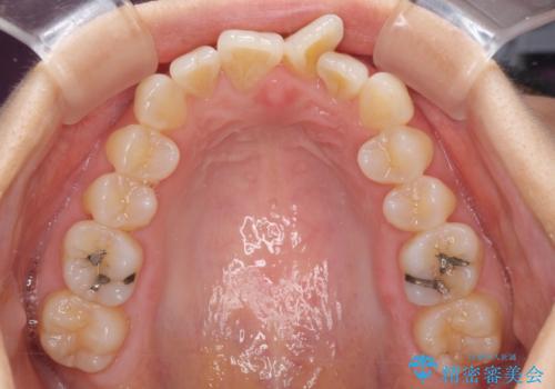 短期間で仕上げたい ワイヤーでの非抜歯矯正の治療前