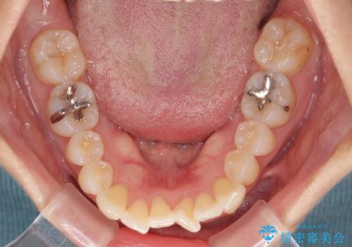 短期間で仕上げたい ワイヤーでの非抜歯矯正の治療前