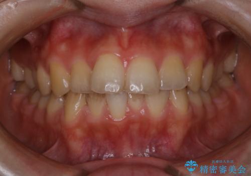 結婚式の前にPMTCで1日できれいな口元にの治療前