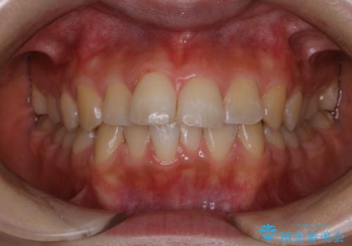 結婚式の前にPMTCで1日できれいな口元にの治療後