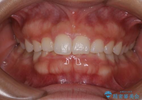 久しぶりの歯のクリーニング(Professional Mechanical Tooth Cleaning)の治療前
