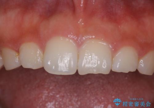 久しぶりの歯のクリーニング(Professional Mechanical Tooth Cleaning)の症例 治療前