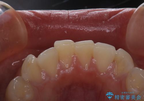 久しぶりの歯のクリーニング(Professional Mechanical Tooth Cleaning)の治療前