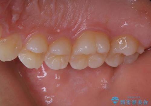 久しぶりの歯のクリーニング(Professional Mechanical Tooth Cleaning)の治療前