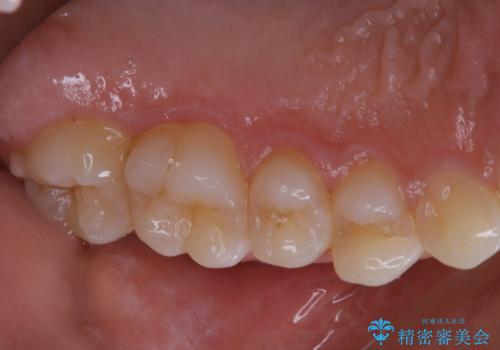 久しぶりの歯のクリーニング(Professional Mechanical Tooth Cleaning)の治療前