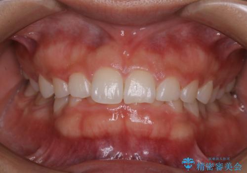 久しぶりの歯のクリーニング(Professional Mechanical Tooth Cleaning)の治療後