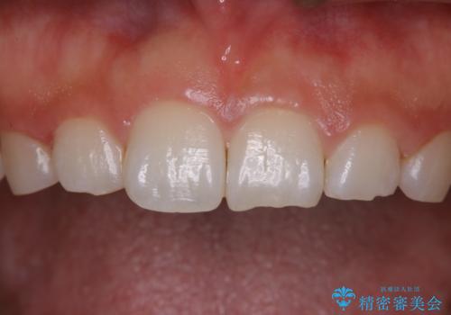 久しぶりの歯のクリーニング(Professional Mechanical Tooth Cleaning)の症例 治療後