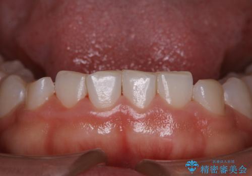 久しぶりの歯のクリーニング(Professional Mechanical Tooth Cleaning)の治療後