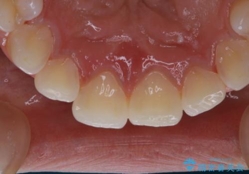 久しぶりの歯のクリーニング(Professional Mechanical Tooth Cleaning)の治療後