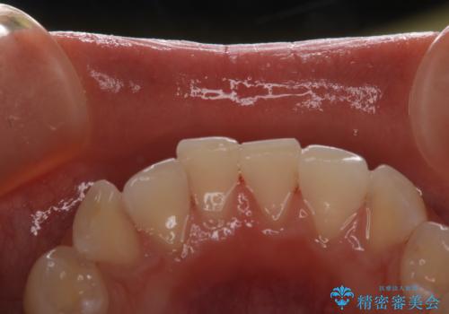久しぶりの歯のクリーニング(Professional Mechanical Tooth Cleaning)の治療後