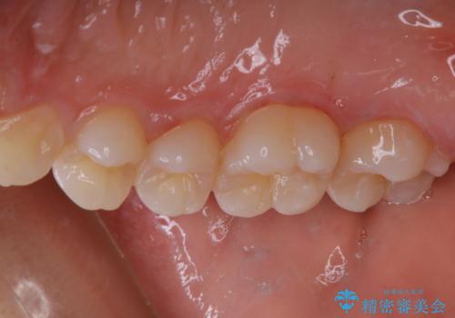 久しぶりの歯のクリーニング(Professional Mechanical Tooth Cleaning)の治療後