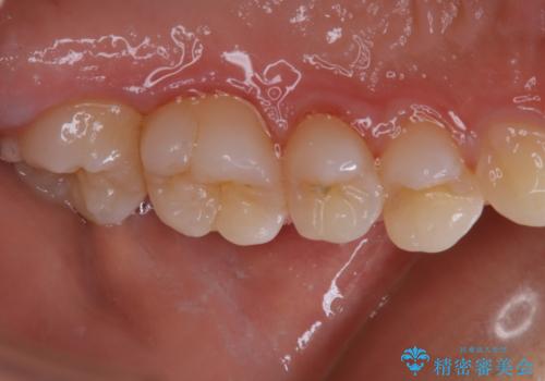 久しぶりの歯のクリーニング(Professional Mechanical Tooth Cleaning)の治療後
