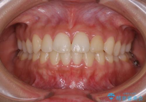 矯正治療終了後にPMTC(Professional Mechanical Tooth Cleaning)の症例 治療前