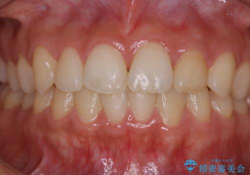 矯正治療終了後にPMTC(Professional Mechanical Tooth Cleaning)の治療前
