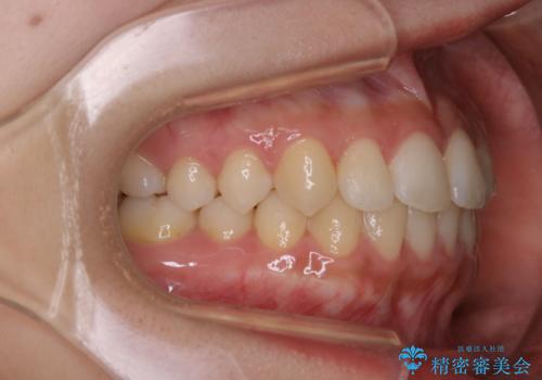 矯正治療終了後にPMTC(Professional Mechanical Tooth Cleaning)の治療前