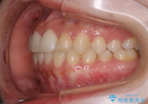 矯正治療終了後にPMTC(Professional Mechanical Tooth Cleaning)の治療前