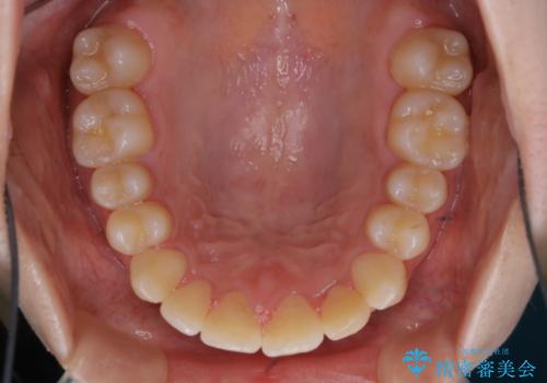 矯正治療終了後にPMTC(Professional Mechanical Tooth Cleaning)の治療前