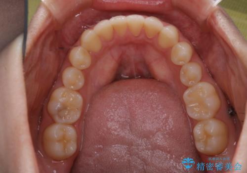 矯正治療終了後にPMTC(Professional Mechanical Tooth Cleaning)の治療前