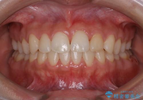 矯正治療終了後にPMTC(Professional Mechanical Tooth Cleaning)の症例 治療後