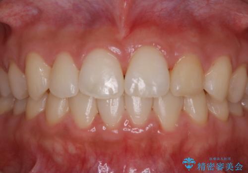 矯正治療終了後にPMTC(Professional Mechanical Tooth Cleaning)