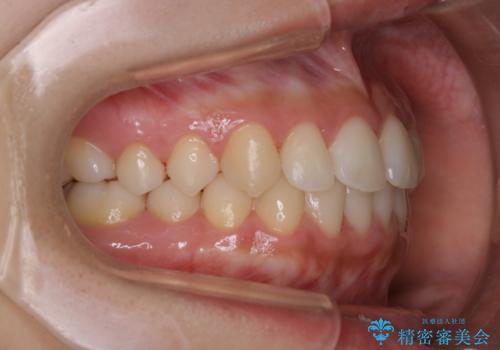 矯正治療終了後にPMTC(Professional Mechanical Tooth Cleaning)の治療後